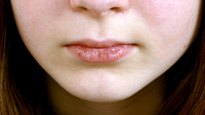 دلایل خشکی دهان, درمان خشکی دهان